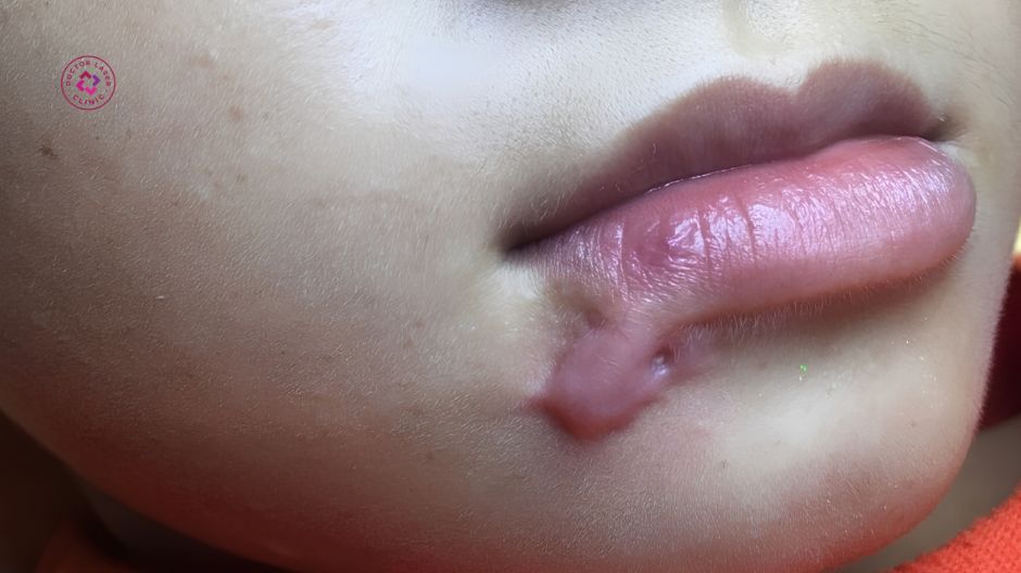 sẹo lồi ở môi là gì