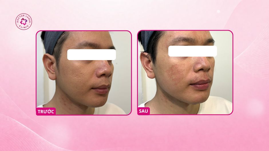 sẹo rỗ hỗn hợp sau laser co2 fractional