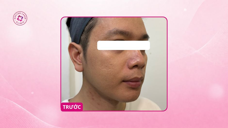 sẹo rỗ hỗn hợp trước điều trị