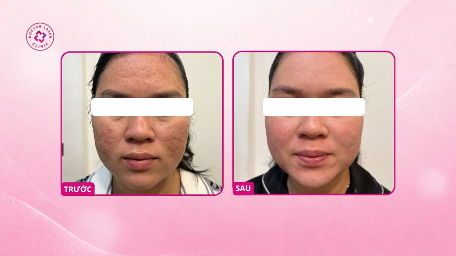 sẹo rỗ lâu năm sau điều trị