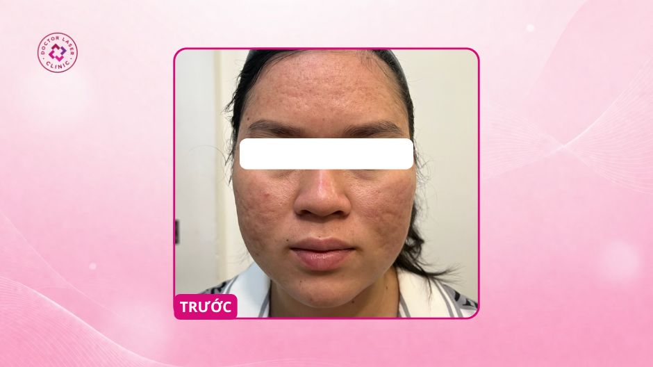 sẹo rỗ lâu năm trước điều trị