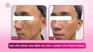 sẹo rỗ nặng hai bên má laser co2 fractional