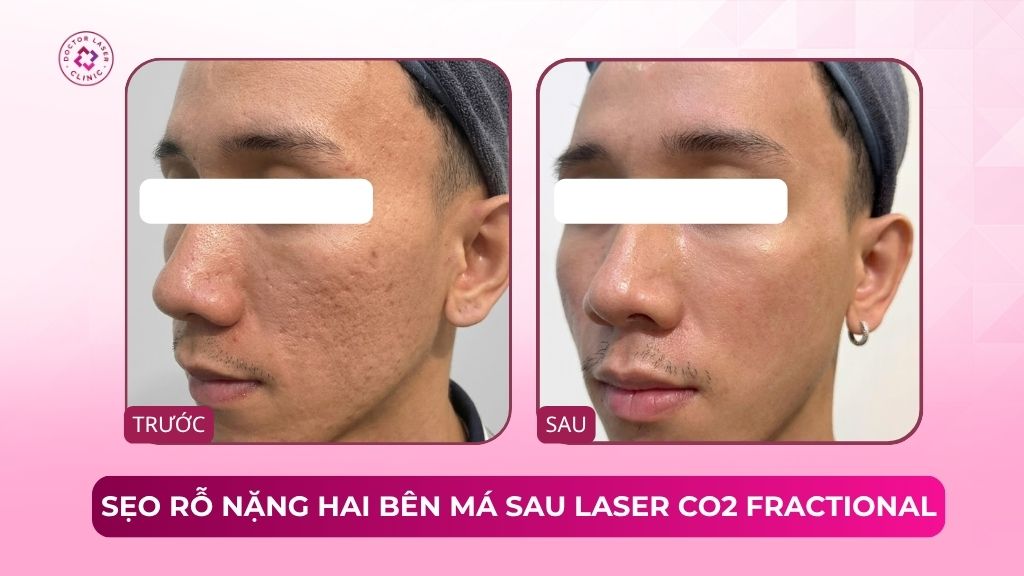 sẹo rỗ nặng hai bên má laser co2 fractional