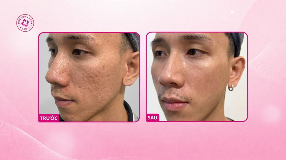 sẹo rỗ nặng hai bên má sau laser co2 fractional
