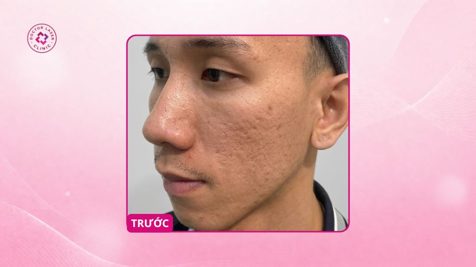 sẹo rỗ nặng hai bên má trước điều trị