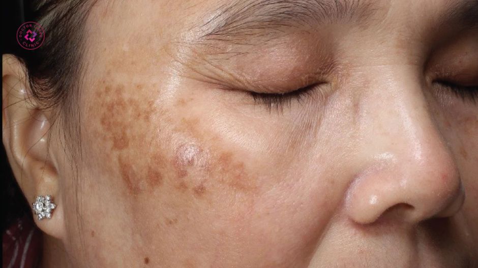 tại sao cần phân biệt các cấp độ nám da