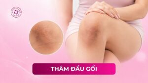 thâm đầu gối