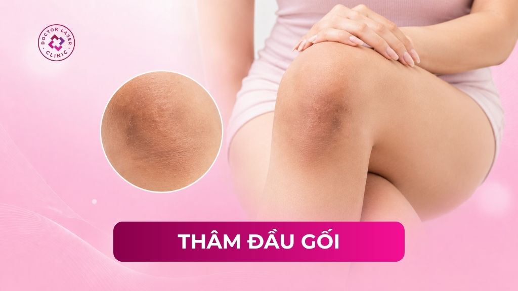 Nguyên nhân thâm đầu gối và cách điều trị chuẩn y khoa