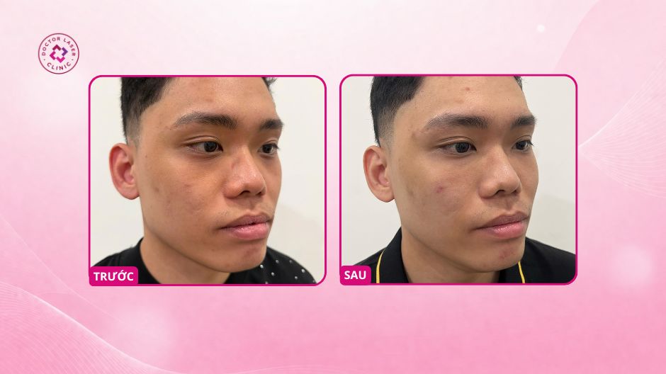 thâm mắt sau tiêm filler