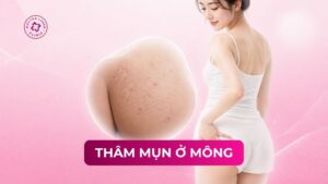 thâm mụn ở mông