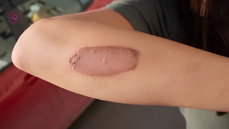 thay đổi cấu trúc collagen sau bỏng