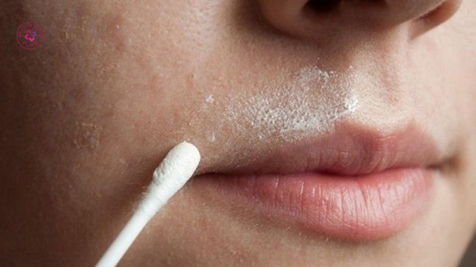 thói quen sinh hoạt gây nám quanh miệng