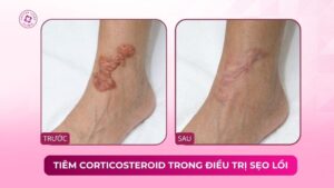 tiêm corticosteroid trong điều trị sẹo lồi
