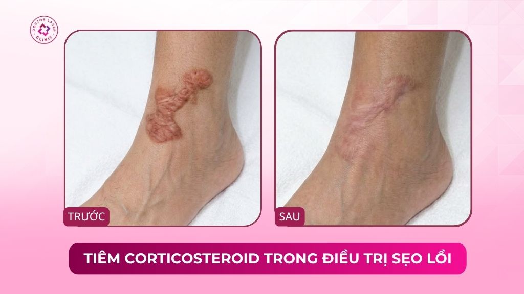 tiêm corticosteroid trong điều trị sẹo lồi