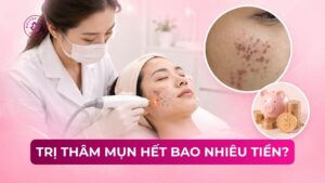 trị thâm mụn hết bao nhiêu tiền