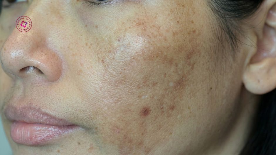 vết nám đậm màu hơn tạm thời sau laser trị nám