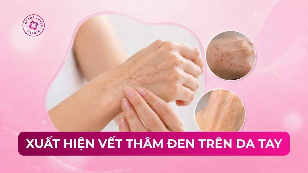 Vì sao xuất hiện vết thâm đen trên da tay? Các phương pháp điều trị