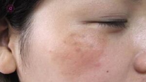 bắn laser pico trị nám nhưng không bong da có hiệu quả không