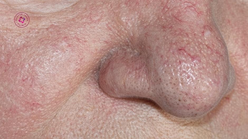 bảng giá điều trị giãn mao mạch mũi