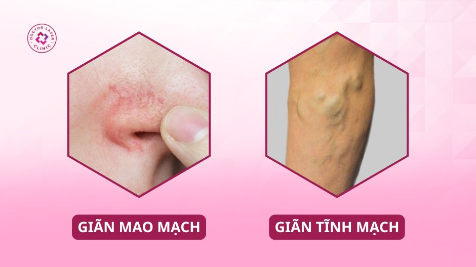 bảng so sánh giãn mao mạch và giãn tĩnh mạch