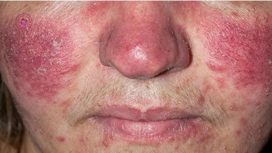 các bệnh da liên quan đến giãn mao mạch