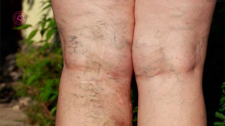 biến chứng của giãn tĩnh mạch