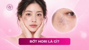 bớt hori là gì