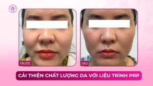 cải thiện chất lượng da với liệu trình prp