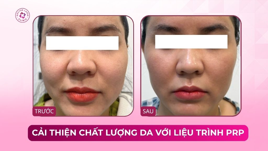 cải thiện chất lượng da với liệu trình prp