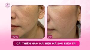 cải thiện nám hai bên má sau điều trị