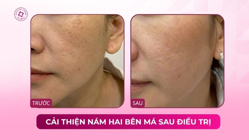 cải thiện nám hai bên má sau điều trị