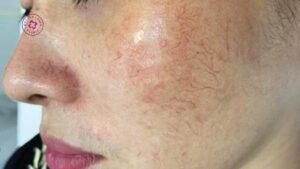 da bị giãn mao mạch có trang điểm được không