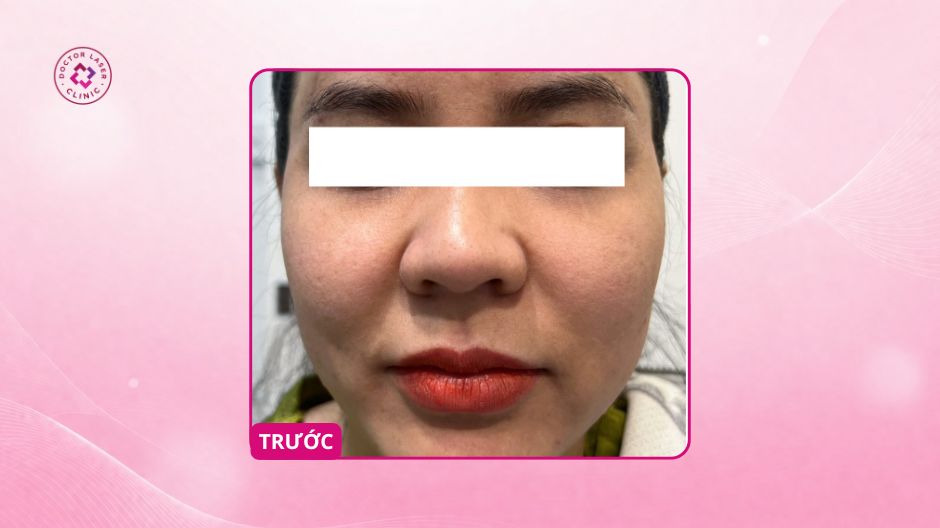 làn da kém tươi trước điều trị prp