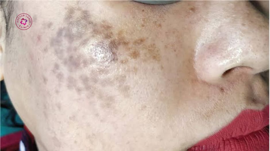 dấu hiệu nhận biết bớt hori