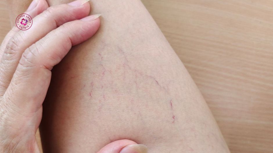 di truyền gây giãn mao mạch ở chân