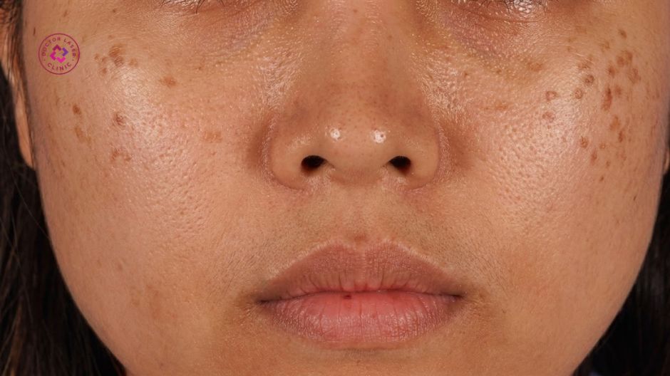 di truyền và yếu tố bẩm sinh bớt hori