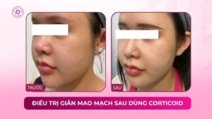 điều trị giãn mao mạch sau dùng corticoid