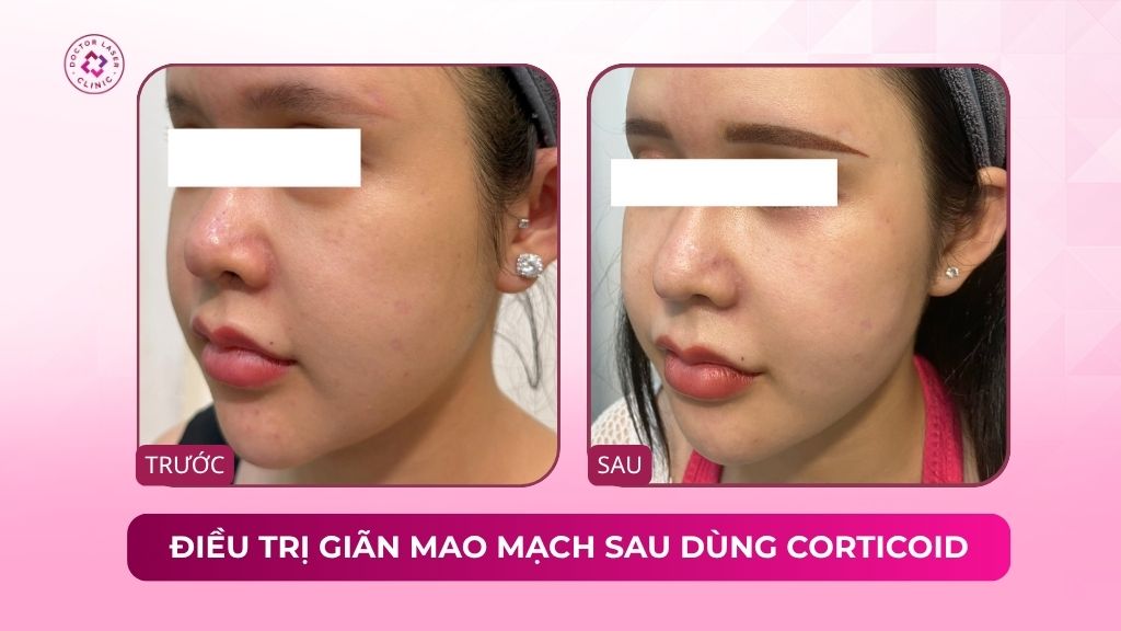 điều trị giãn mao mạch sau dùng corticoid