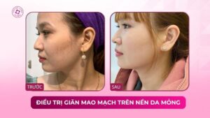 điều trị giãn mao mạch trên nền da mỏng