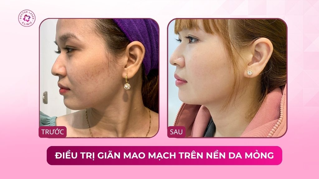 điều trị giãn mao mạch trên nền da mỏng