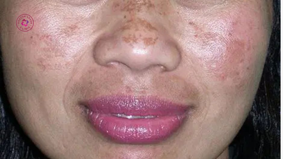 điều trị nám