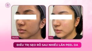 điều trị sẹo rỗ sau nhiều lần peel da không cải thiện điều trị sẹo rỗ sau nhiều lần peel da không cải thiện