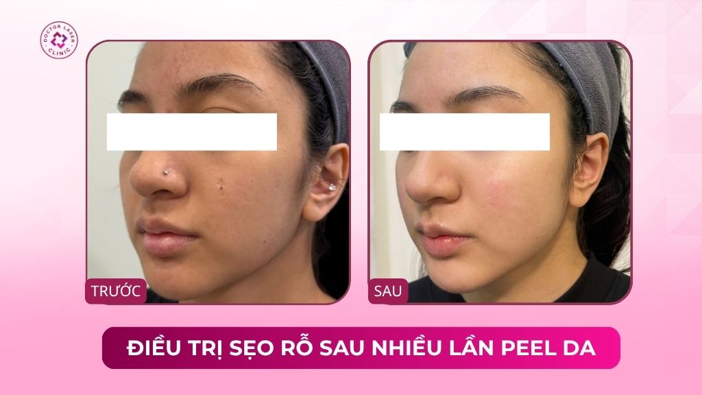 điều trị sẹo rỗ sau nhiều lần peel da không cải thiện