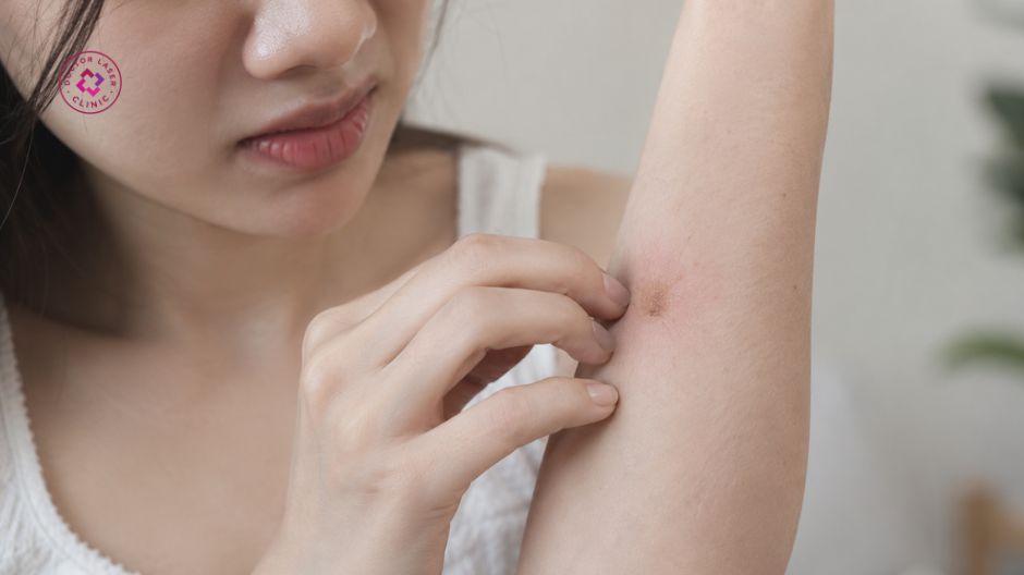 đỏ và châm chích khi trị vết thương lên da non bị thâm