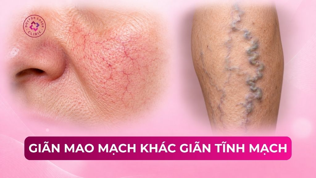 So sánh giãn mao mạch khác giãn tĩnh mạch ở đâu?