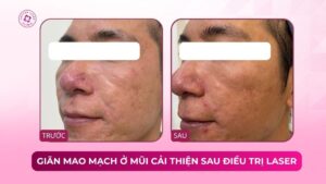 giãn mao mạch ở mũi cải thiện sau điều trị laser