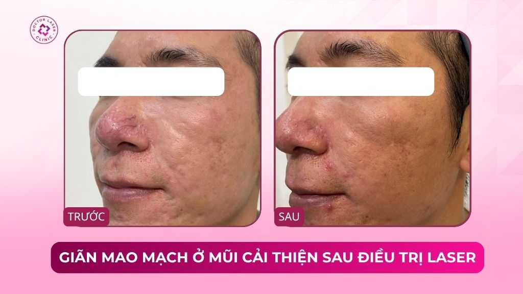 giãn mao mạch ở mũi cải thiện sau điều trị laser