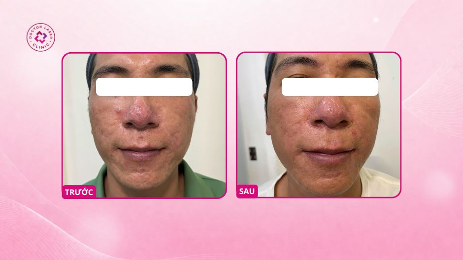 giãn mao mạch ở mũi sau 3 buổi điều trị laser