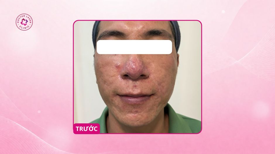 giãn mao mạch ở mũi trước điều trị laser