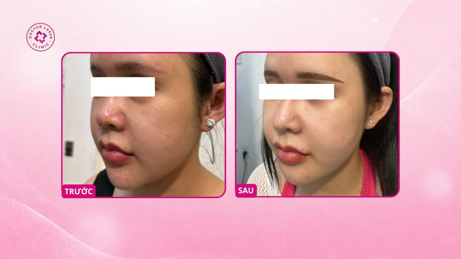 kết quả điều trị giãn mao mạch sau 3 buổi laser magicveins